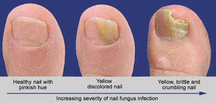 toenail fungus